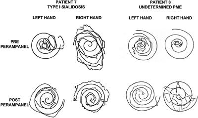 Perampanel Improves Cortical Myoclonus and Disability in Progressive Myoclonic Epilepsies: A Case Series and a Systematic Review of the Literature